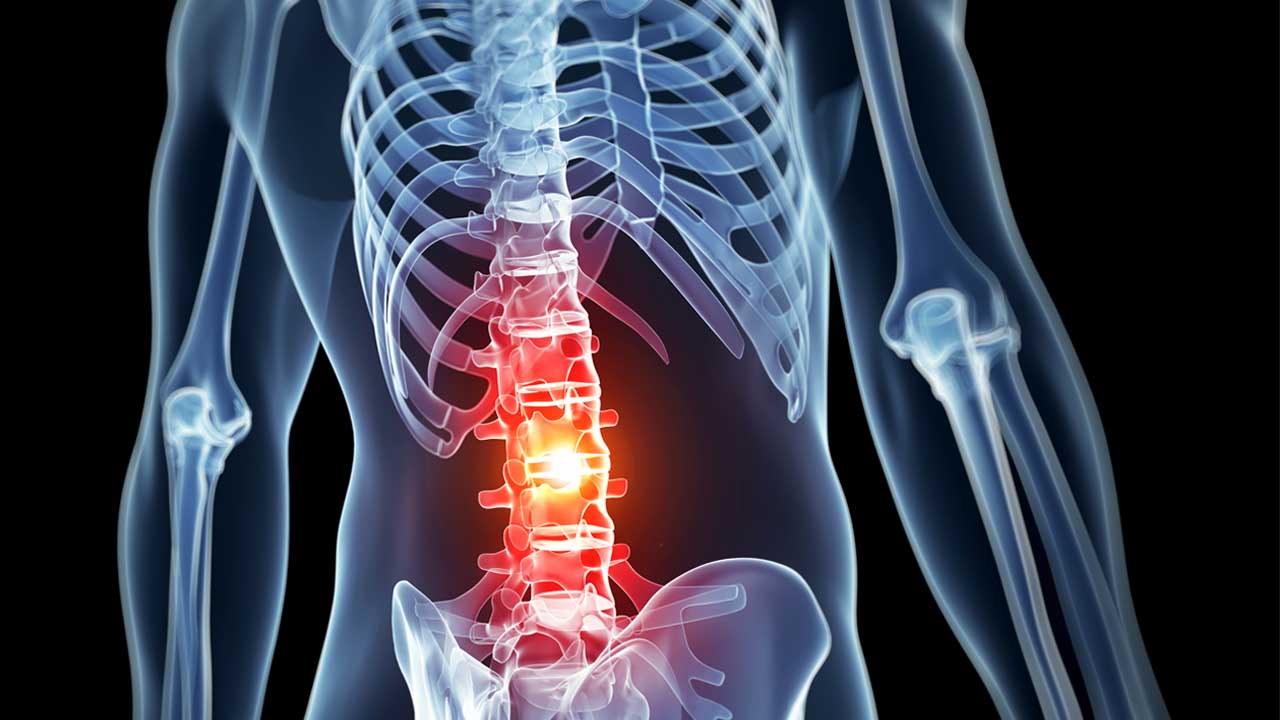 back pain - Burley Stroker Chiropractic